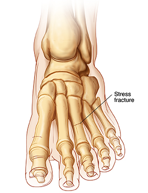Front view of ankle and foot bones showing stress fracture in metatarsal bone.