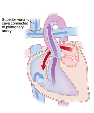 Front view cross section of heart showing bidirectional Glenn procedure for hypoplastic left ventricle. Superior vena cava is connected to pulmonary artery. Arrows show blood flowing from left atrium to right ventricle and mixing with blood from inferior vena cava, then being pumped out aorta.
